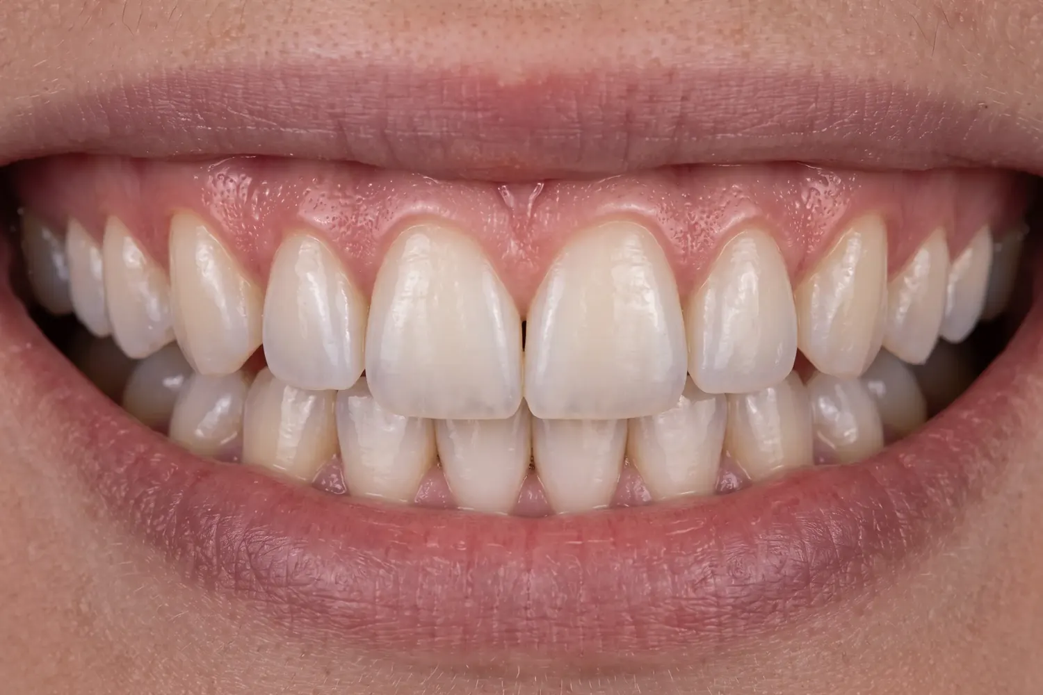 Ilustração do procedimento: Plástica periodontal